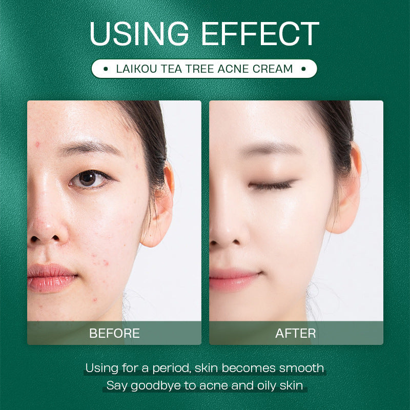 Tea Tree Anti Acne Face Cream